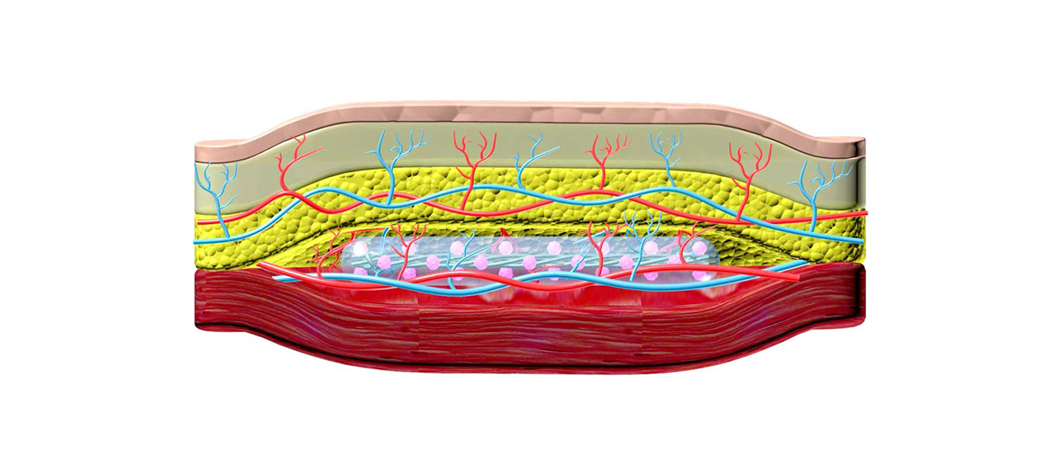Ученые разработали имплантат под кожу для лечения сахарного диабета 1 типа