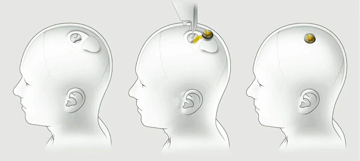 Компании Илона Маска запретили проводить испытание мозгового импланта на людях
