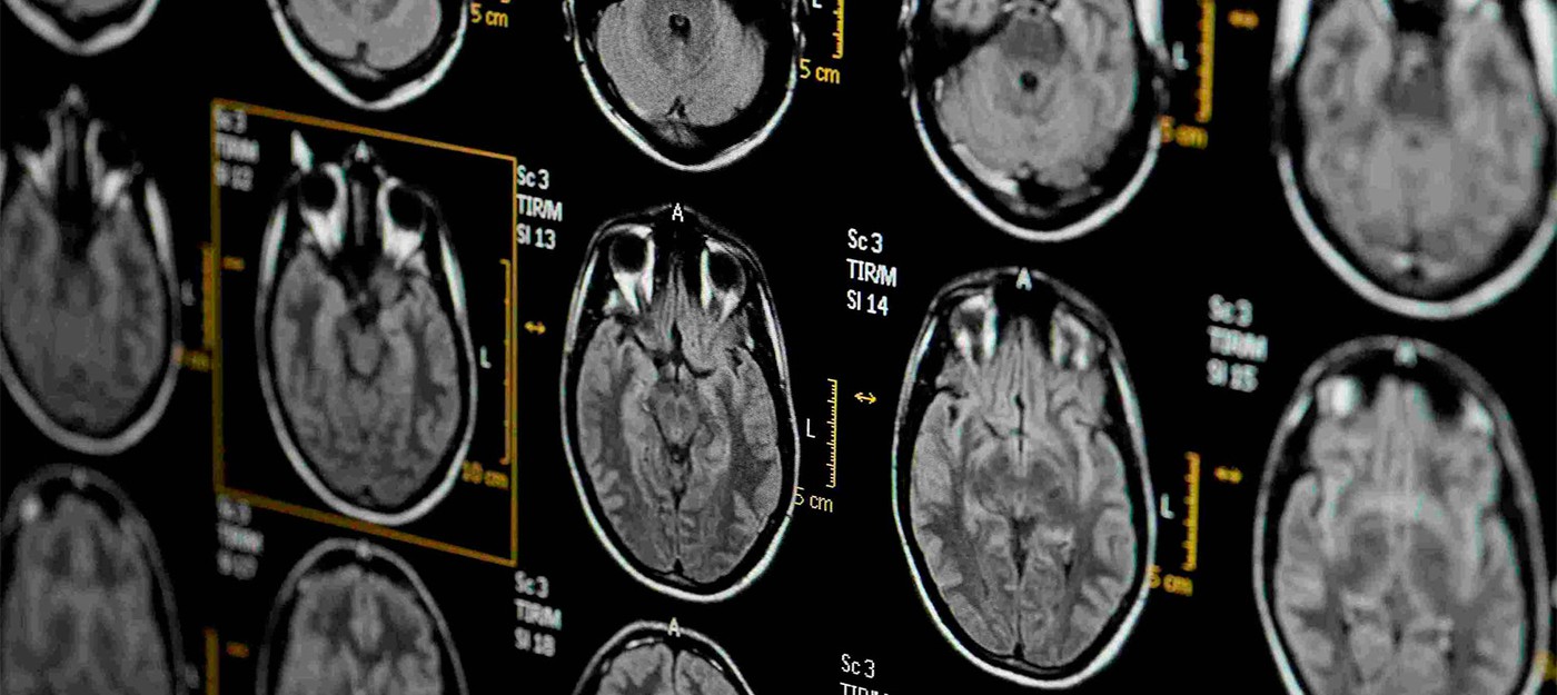 Исследования не обнаружили доказательств травмы мозга в случаях "гаванского синдрома"