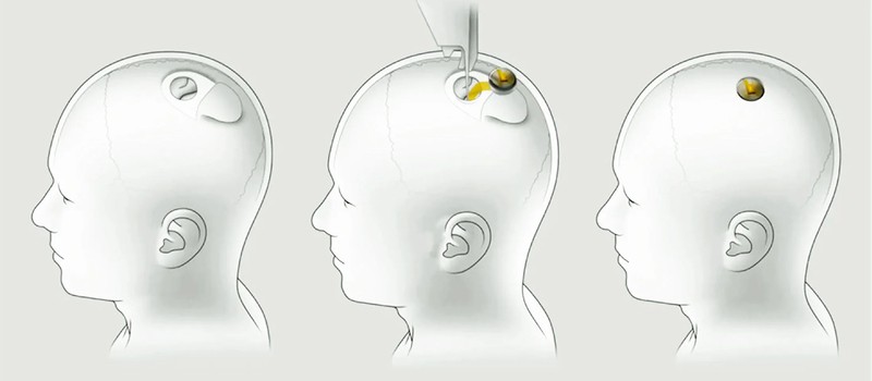 Компании Илона Маска запретили проводить испытание мозгового импланта на людях