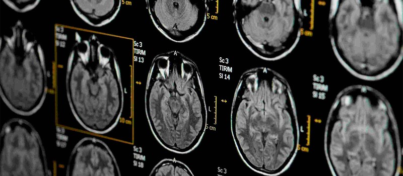 Исследования не обнаружили доказательств травмы мозга в случаях "гаванского синдрома"